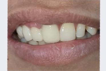 After Smile Transformation
