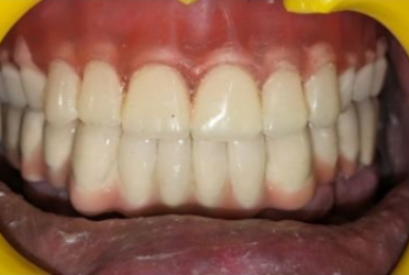 After Full Mouth Rehab