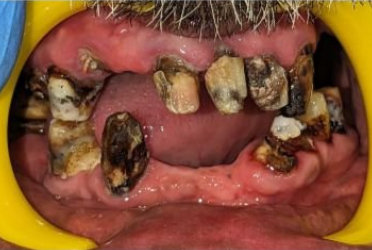 Before Full Mouth Rehab