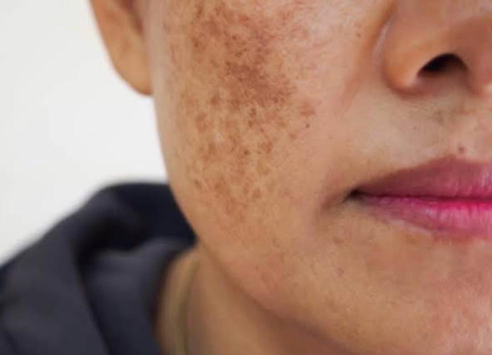 Skin Depigmentation