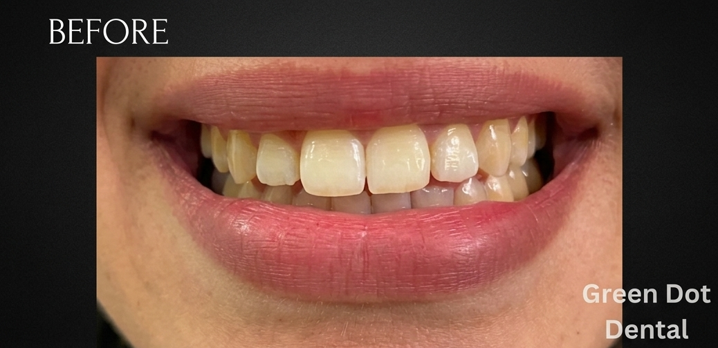 Before Whitening